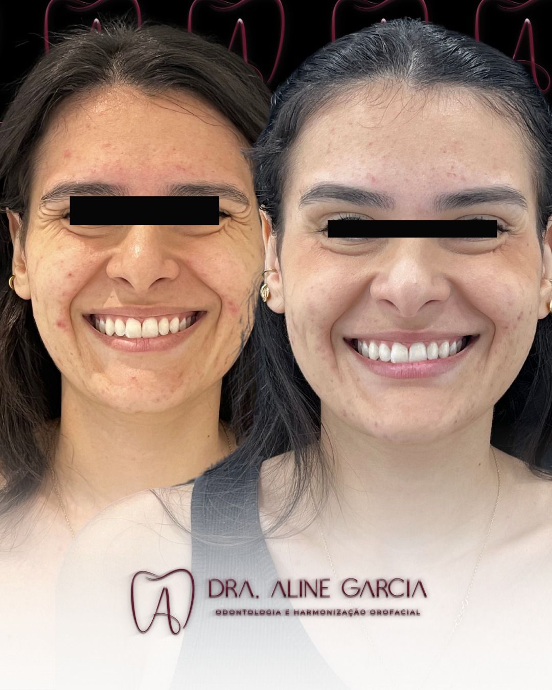 Antes e depois de paciente sorrindo, com marcas de expressão na testa suavizadas, destacando os resultados do tratamento estético.