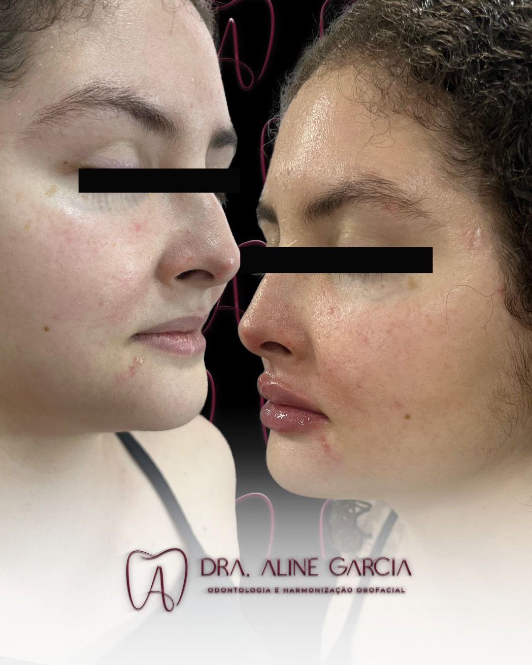 Antes e depois de um procedimento nos lábios de uma paciente, mostrando a melhoria no volume e contorno labial.