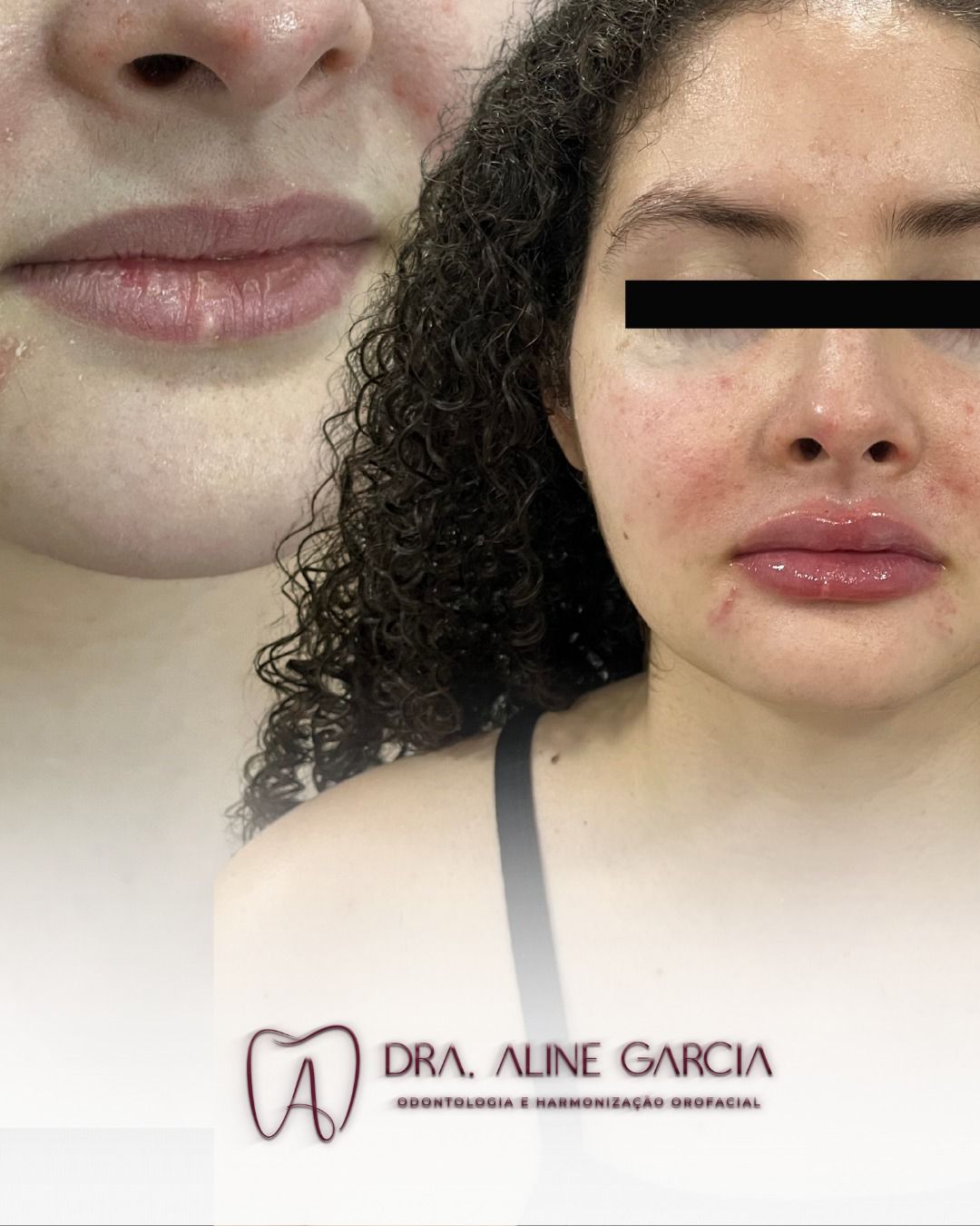 Antes e depois de procedimento realizado nos lábios de uma paciente, mostrando a transformação e o aumento de volume labial.