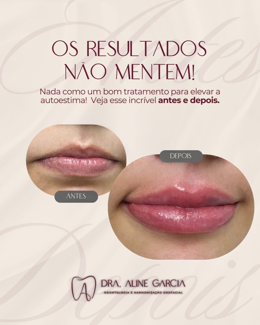 Antes e depois de um procedimento nos lábios, mostrando aumento de volume e definição.