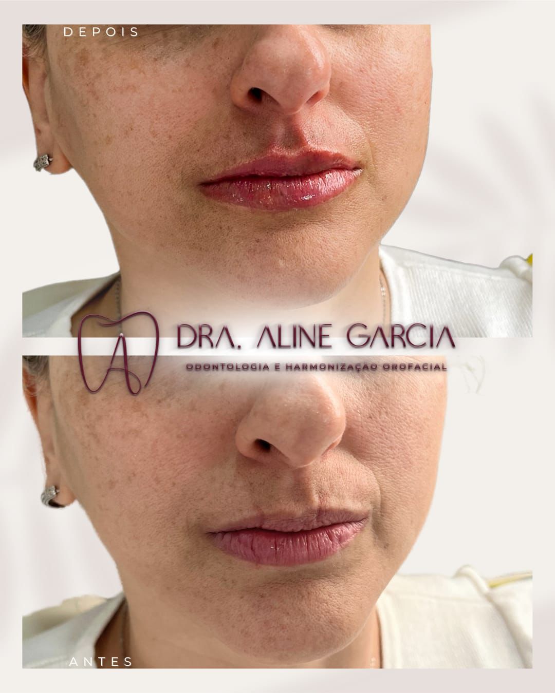 Antes e depois de procedimento nos lábios, mostrando aumento de volume e definição natural.