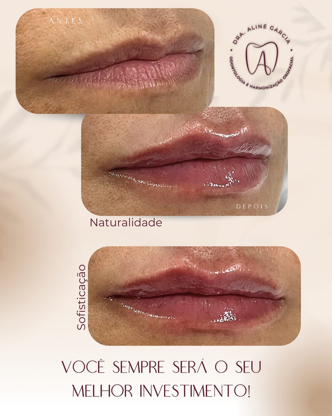 Três imagens dos lábios de uma paciente após o procedimento, mostrando resultados naturais e harmônicos.