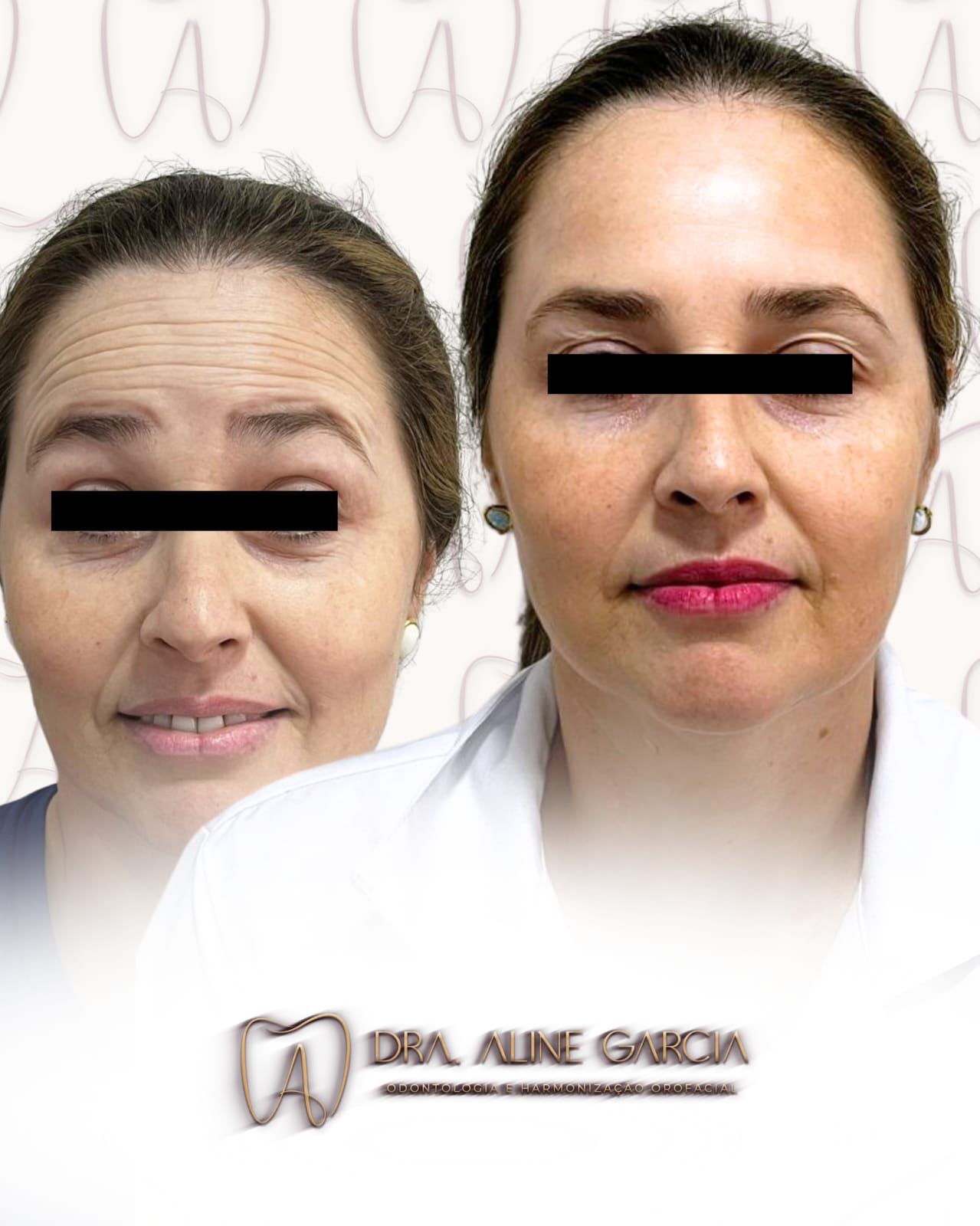 Antes e depois de lábios de uma cliente, mostrando aumento de volume e contorno mais definido.
