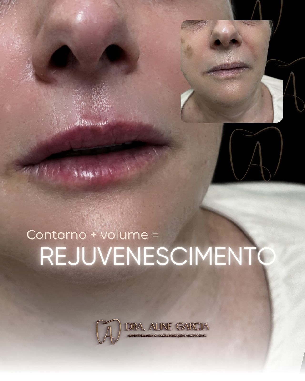Imagem de antes e depois de uma paciente sorrindo de perfil, destacando o aumento de volume e a definição natural dos lábios após o procedimento estético.