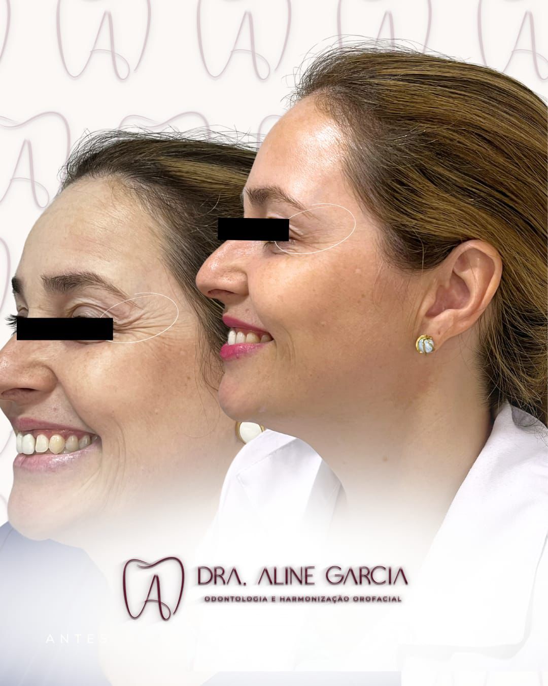 Antes e depois do procedimento nos lábios de uma paciente sorrindo de perfil, evidenciando aumento de volume e contorno definido.