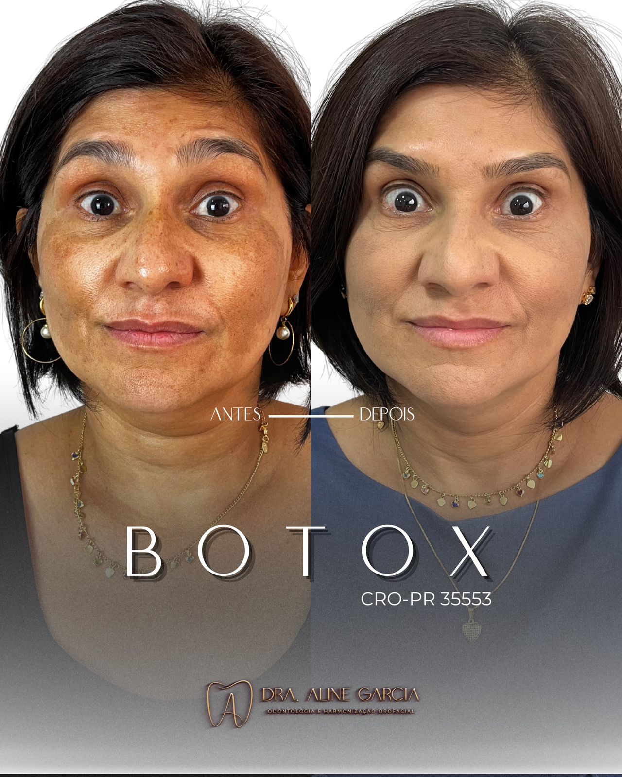 Antes e depois de paciente feminina, fazendo várias expressões faciais, mostrando os resultados bem-sucedidos do procedimento estético.