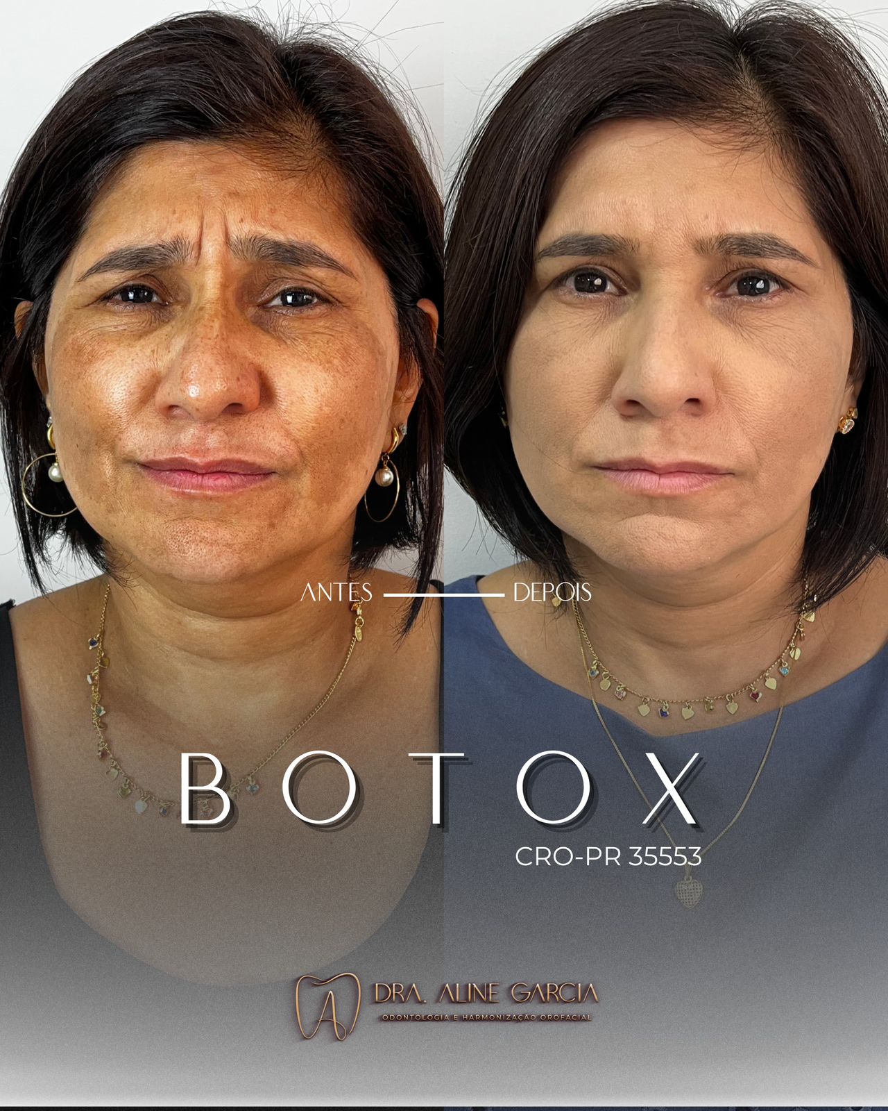 Antes e depois de paciente feminina fazendo várias expressões faciais, mostrando que o procedimento foi um sucesso e proporcionou resultados naturais.