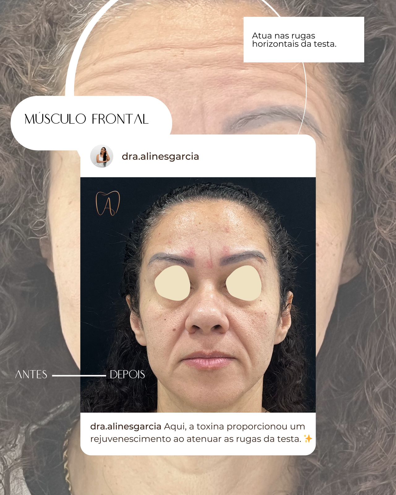 Antes e depois de uma paciente corrigindo rugas e marcas de expressão, mostrando a suavização e rejuvenescimento da pele.