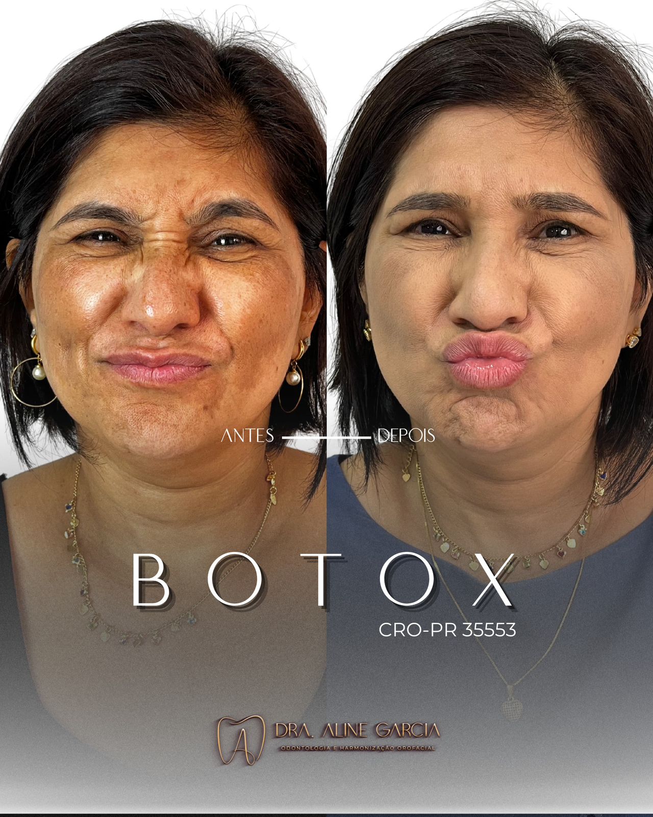Antes e depois de paciente feminina fazendo várias expressões faciais, mostrando o sucesso do procedimento estético.