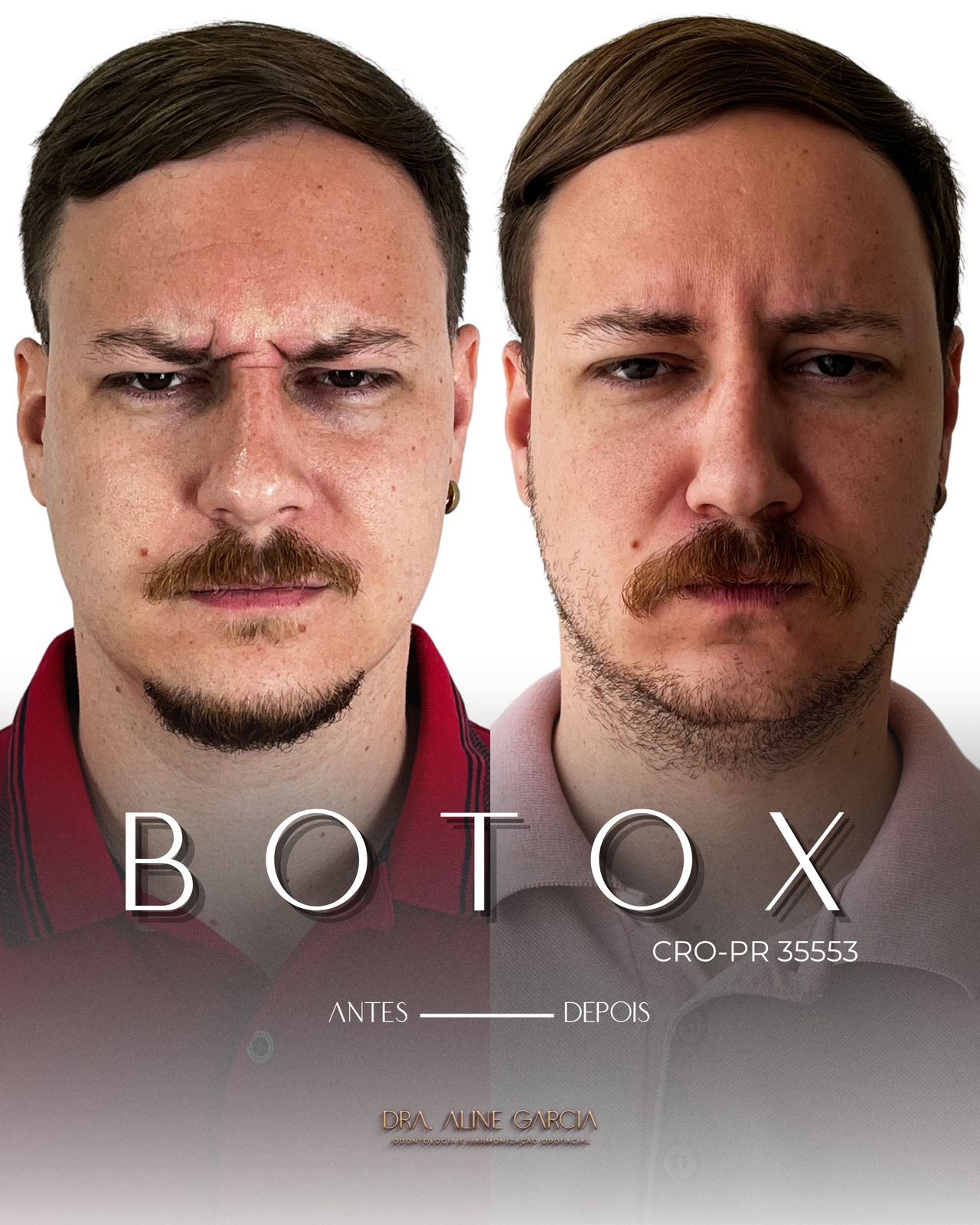 Antes e depois de um paciente masculino fazendo várias expressões faciais, mostrando os resultados bem-sucedidos do procedimento.