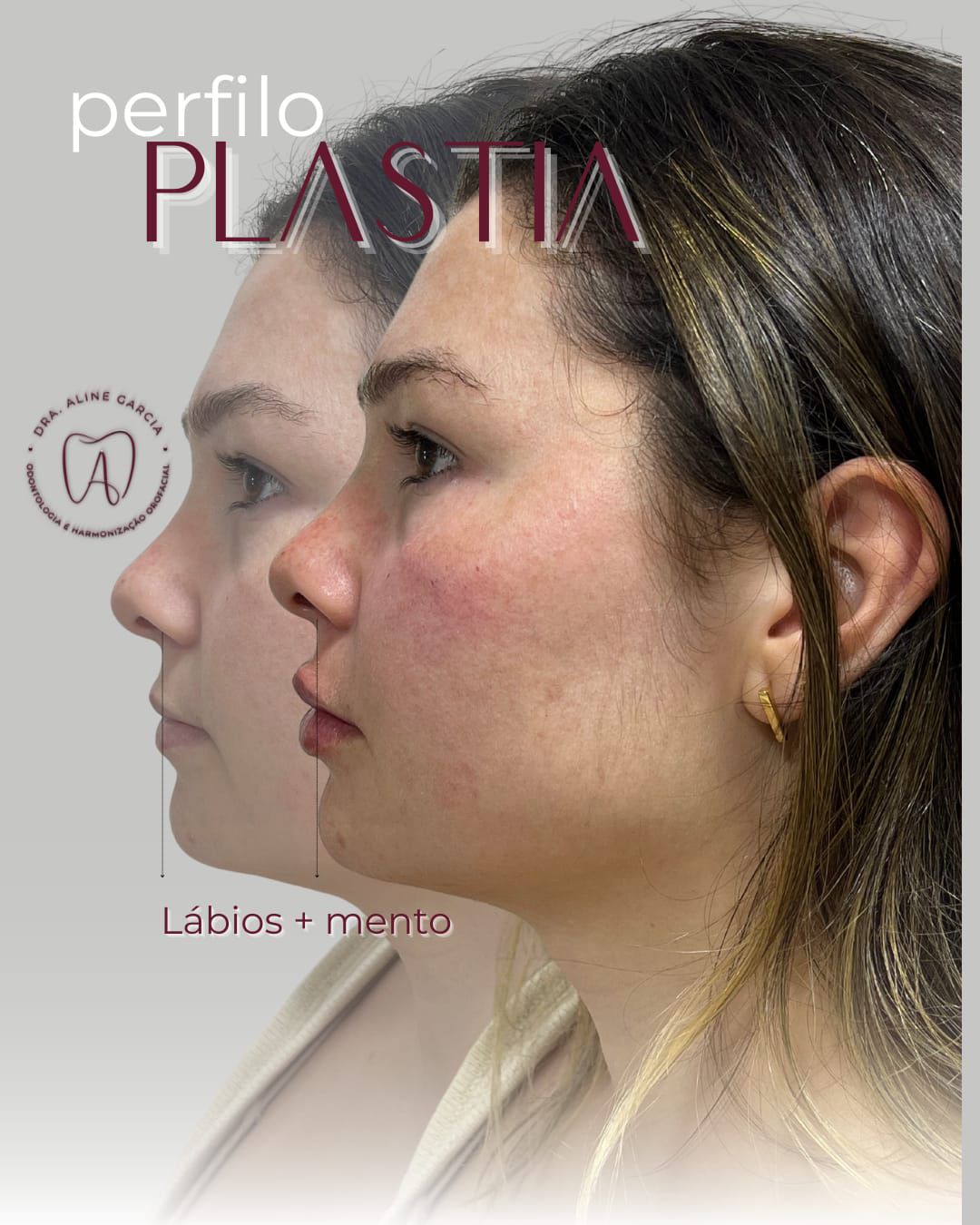Antes e depois de paciente feminina realizando perfiloplastia, mostrando a transformação no contorno facial e harmonia do perfil.