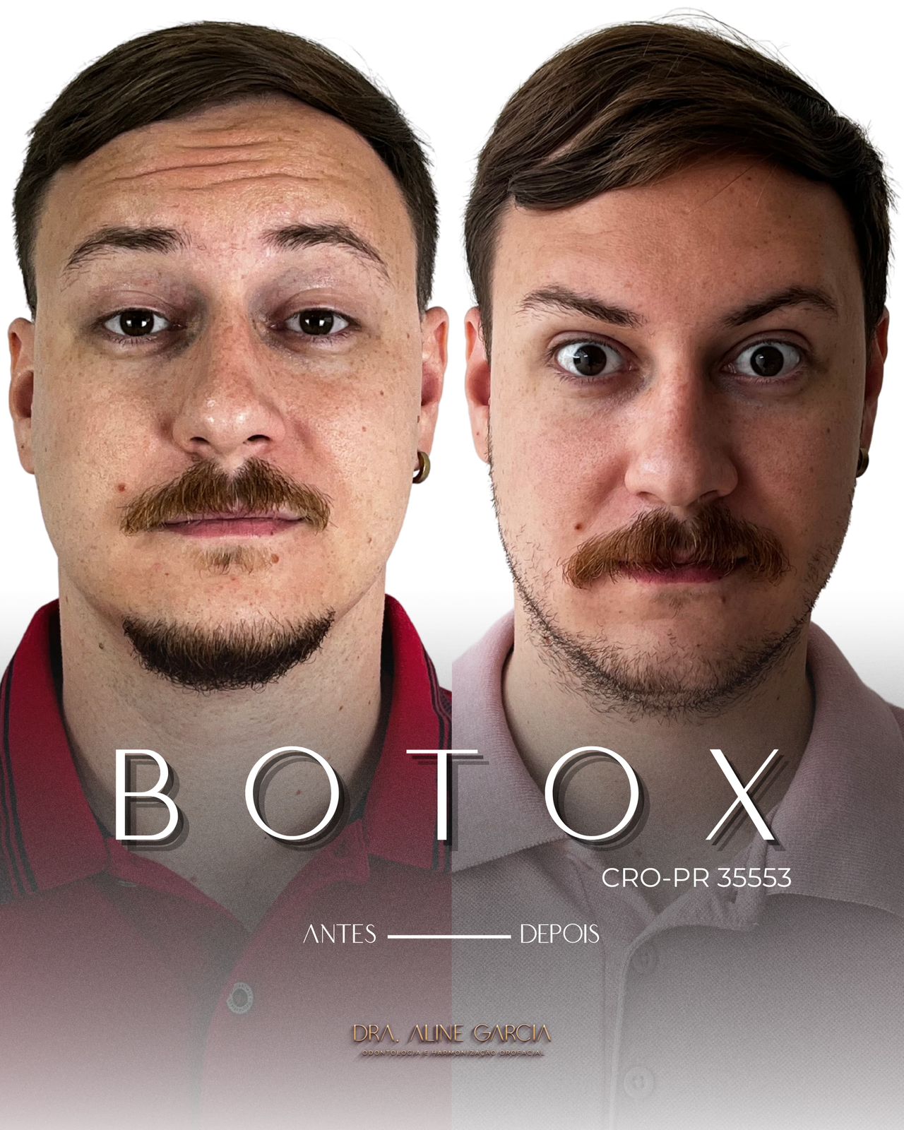 Antes e depois de um paciente masculino fazendo várias expressões faciais, demonstrando o sucesso do procedimento estético.