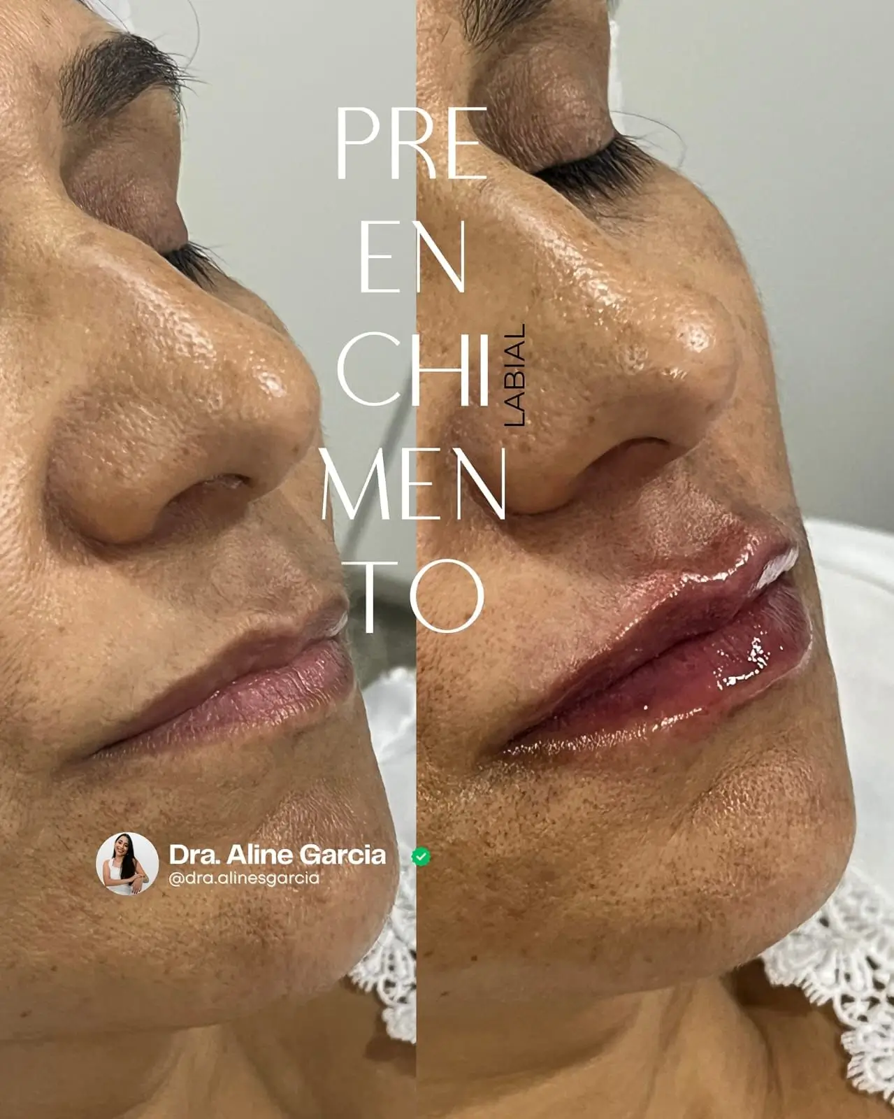 Antes e depois de procedimento nos lábios femininos, mostrando aumento de volume e contorno mais definido.