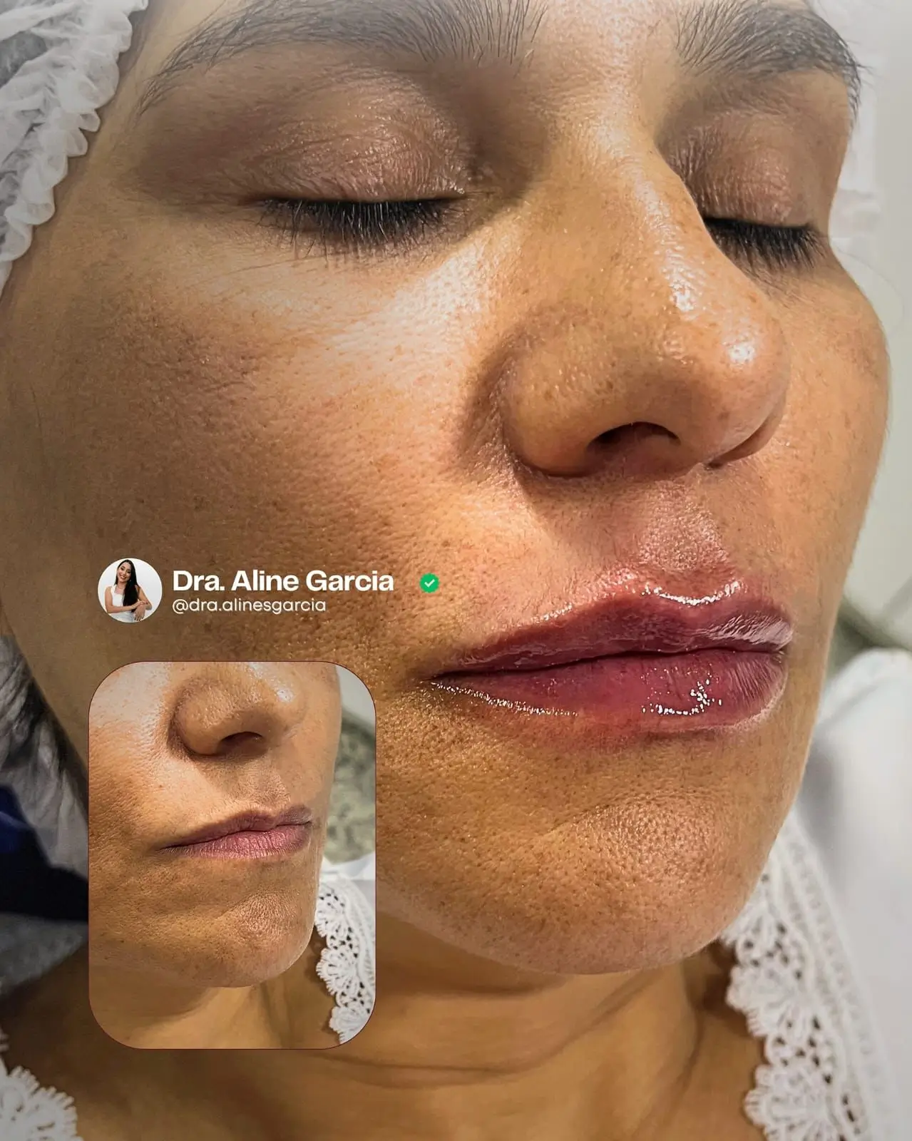 Antes e depois de procedimento nos lábios de paciente feminina, mostrando aumento de volume e definição natural.